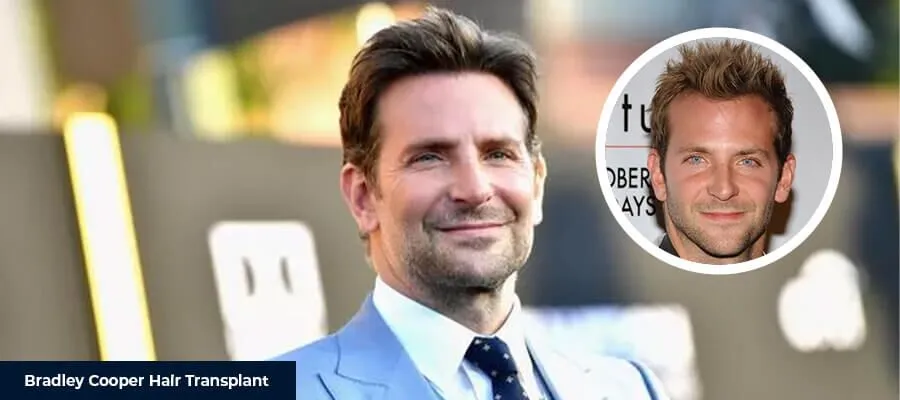 Пересадка волос Bradley Cooper