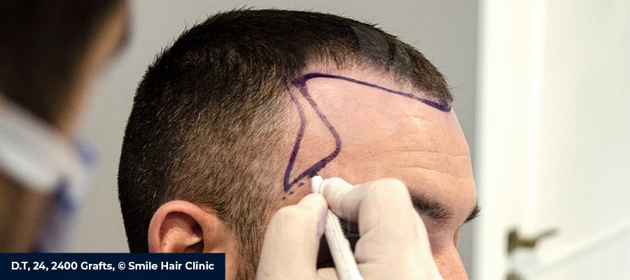 Sideburn Transplantation