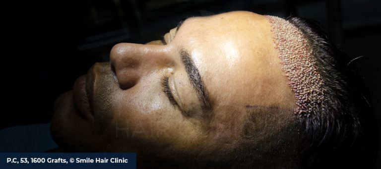 Transplante de cabelo sem barba