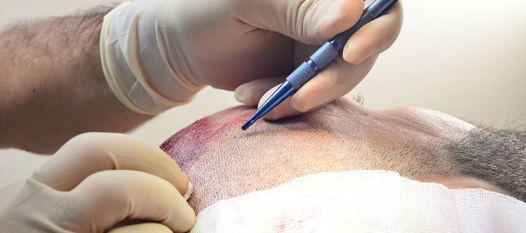 MBJELLJA E FLOKËVE ME MIKRO FUE