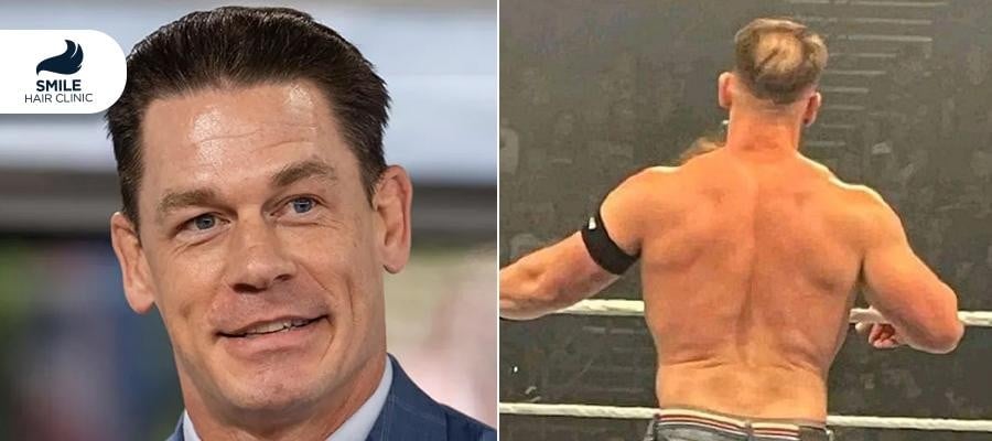 John Cena Hair Transplant: The Story Behind His Transformation