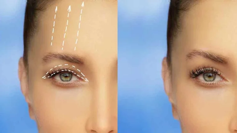 Göz Kapağı Ameliyatı (Blefaroplasti)