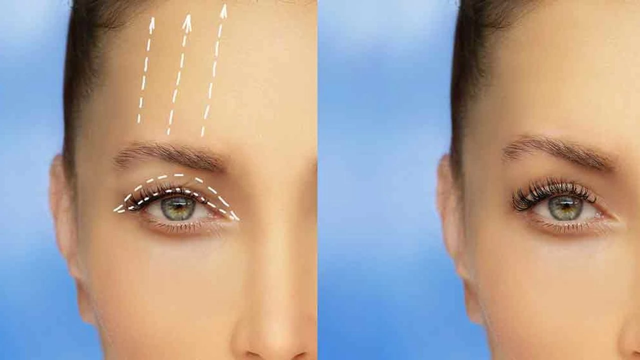 Eyelid Surgery (Blepharoplasty)