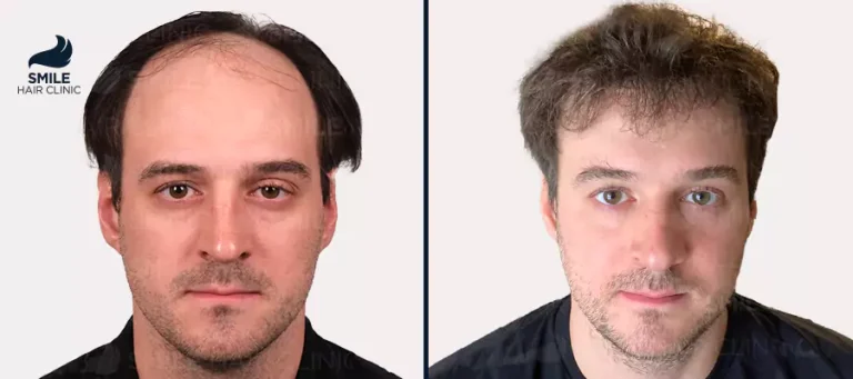 Hair Graft Turkey: Complete Guide to Costs, Procedures, and Results in 2026