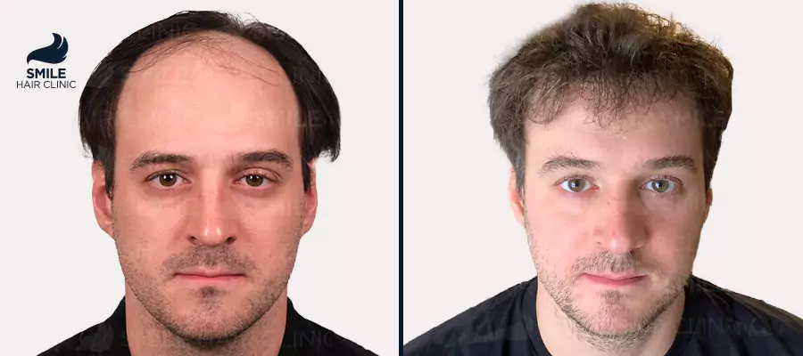 Hair Graft Turkey: Complete Guide to Costs, Procedures, and Results in 2026