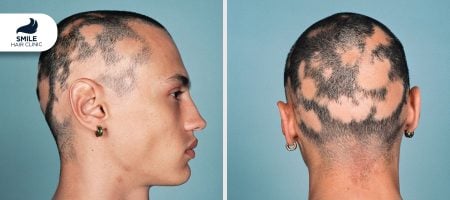 alopecia