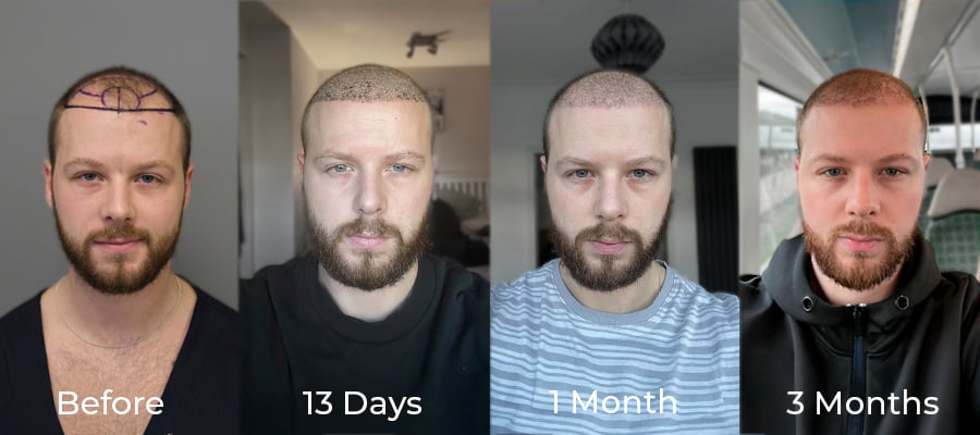 Washing & Scab Removal: Day-by-Day Guide with Photos (0–14 Days)