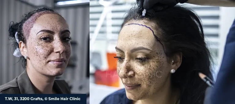 Can Women Get Hair Transplants? Female Hair Restoration Guide