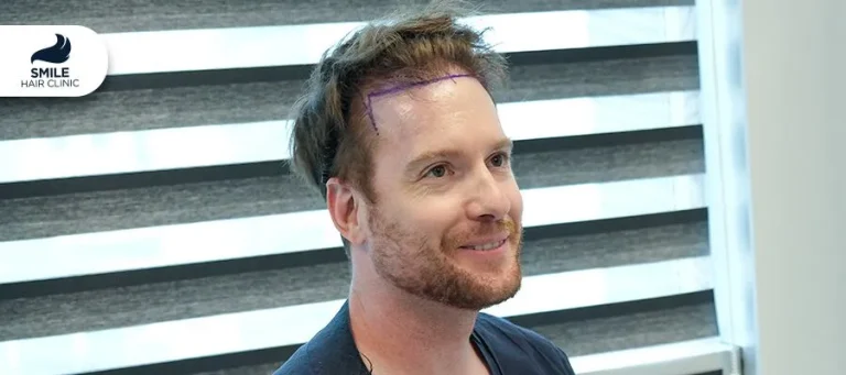 Top Hair Implants New York