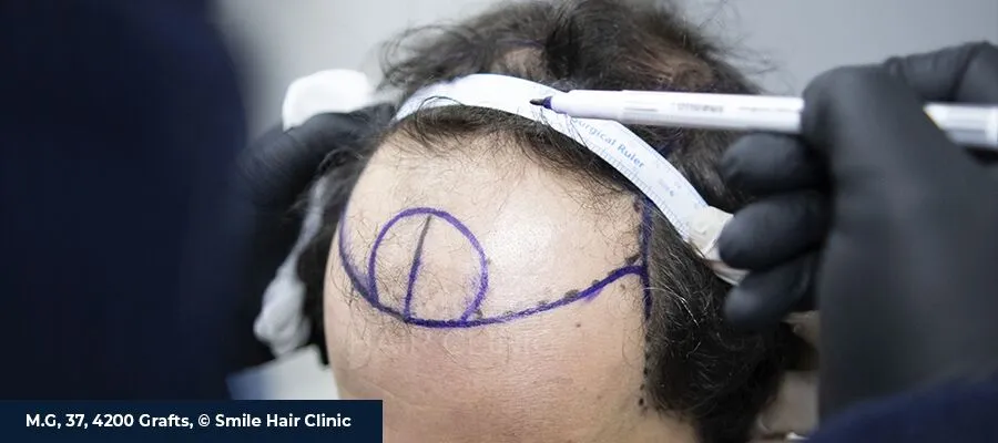 Norwood Scale Explained (Stages 1–7): What You Can Achieve at Each Stage