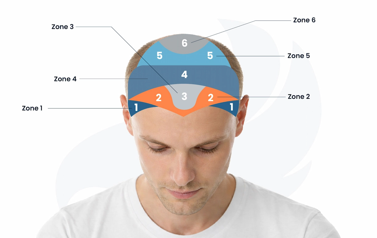 Norwood Scale Scalp Area