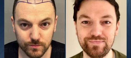 hair-transplant-turkey-before-after-3
