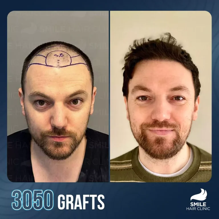 Cobblestoning Hair Transplant: Causes, Fixes & Prevention Guide