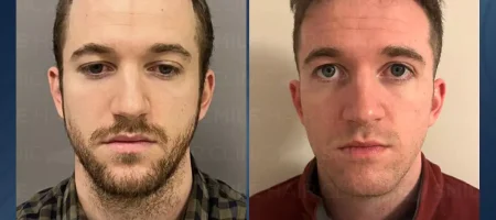 hair-transplant-turkey-before-after-5