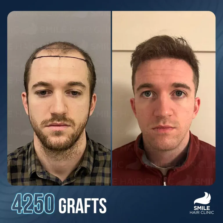 Where Do Hair Transplants Come From? Donor Area Explained