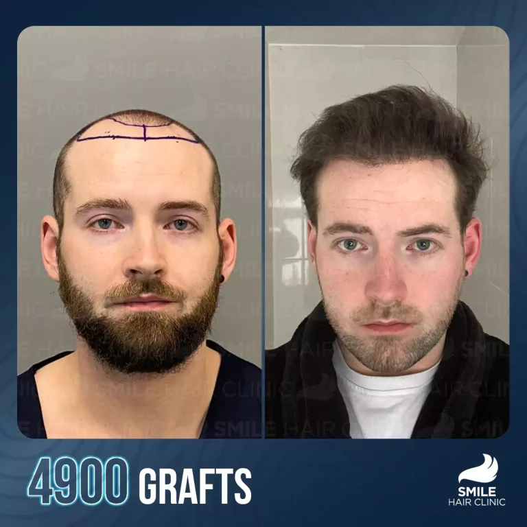 What Is a Hair Transplant? Procedure, Cost, Results & Recovery Guide