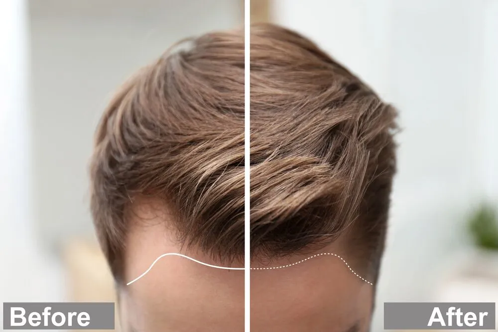 Hairline Design Guide (Male vs Female): Angles, Density & Face Proportions