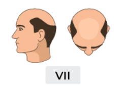 Norwood Scale Explained (Stages 1–7): What You Can Achieve at Each Stage 7 norwood stage 7