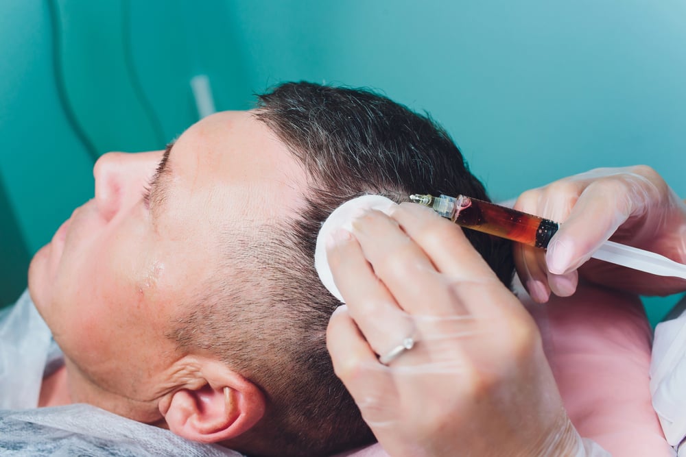 PRP Hair Treatment 4 PRP Hair Treatment