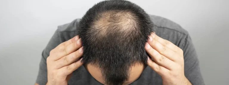 Shock Loss vs Normal Shedding: What’s Expected After a Hair Transplant?