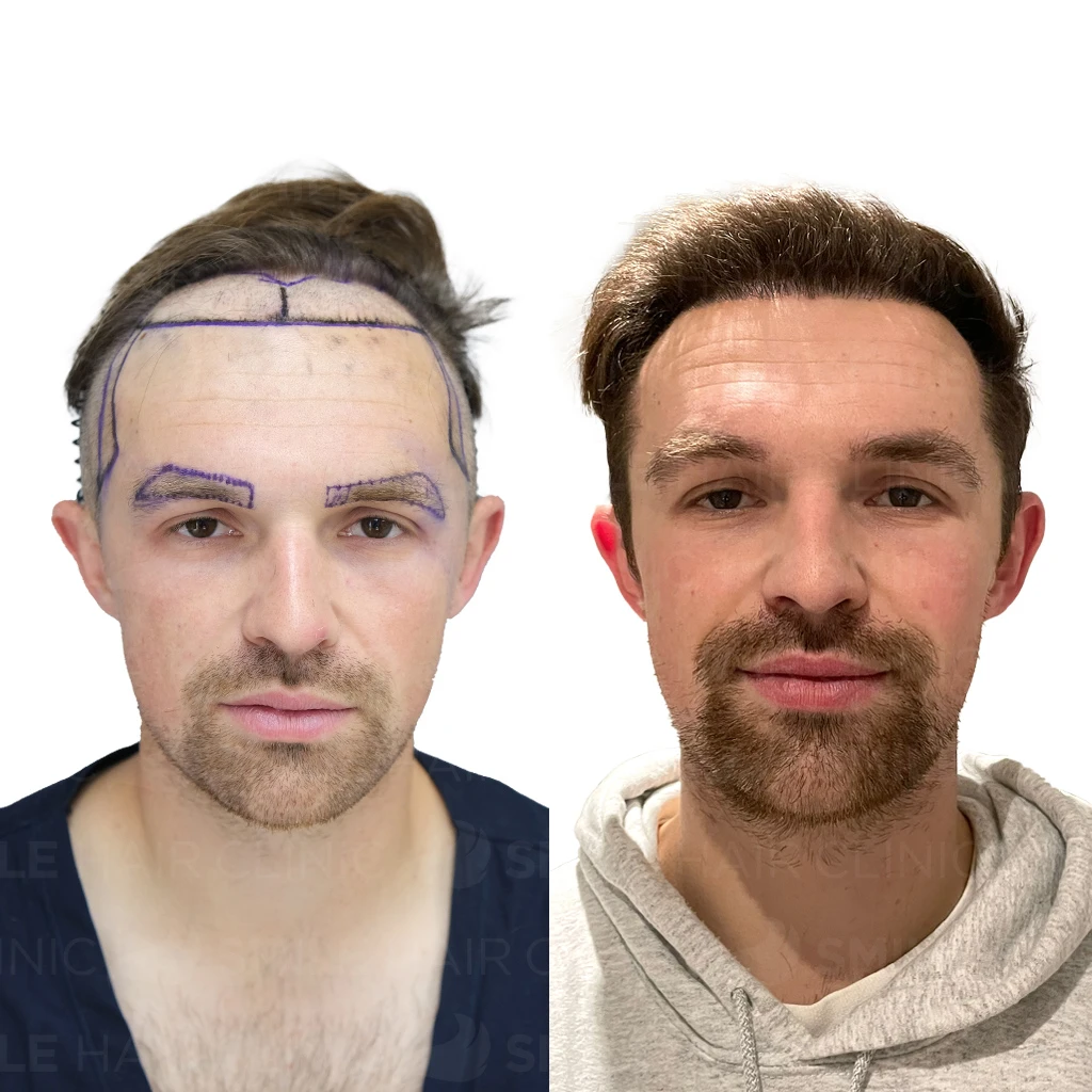 Hair Transplant Turkey Cost 32 2,000 Grafts Hair Transplant Turkey