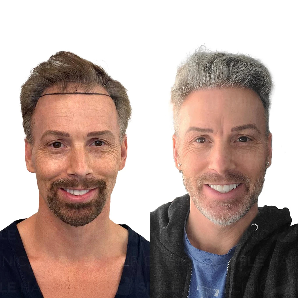 Hair Transplant Turkey Cost 33 3,000 Grafts Hair Transplant Turkey