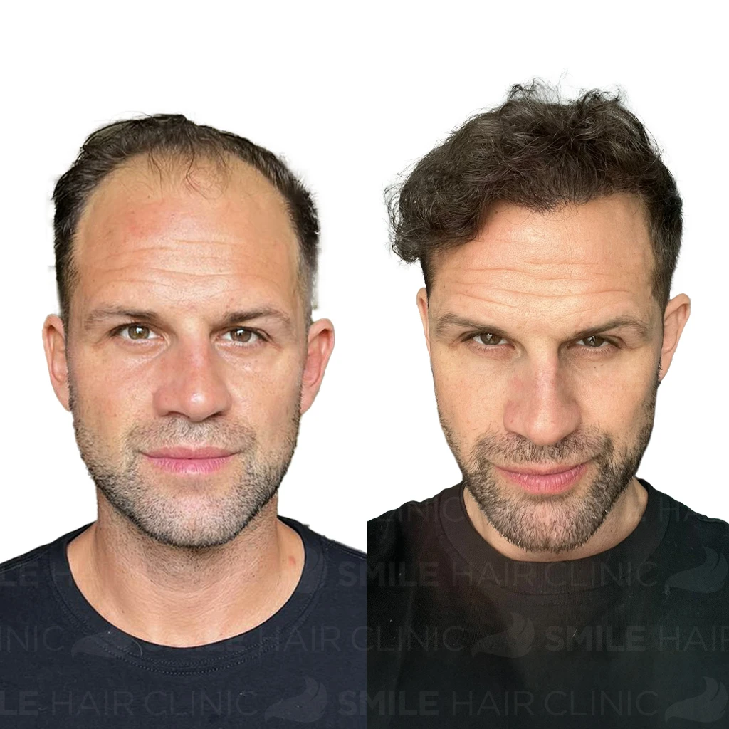 Hair Transplant Turkey Cost 34 4,000 Grafts Hair Transplant Turkey