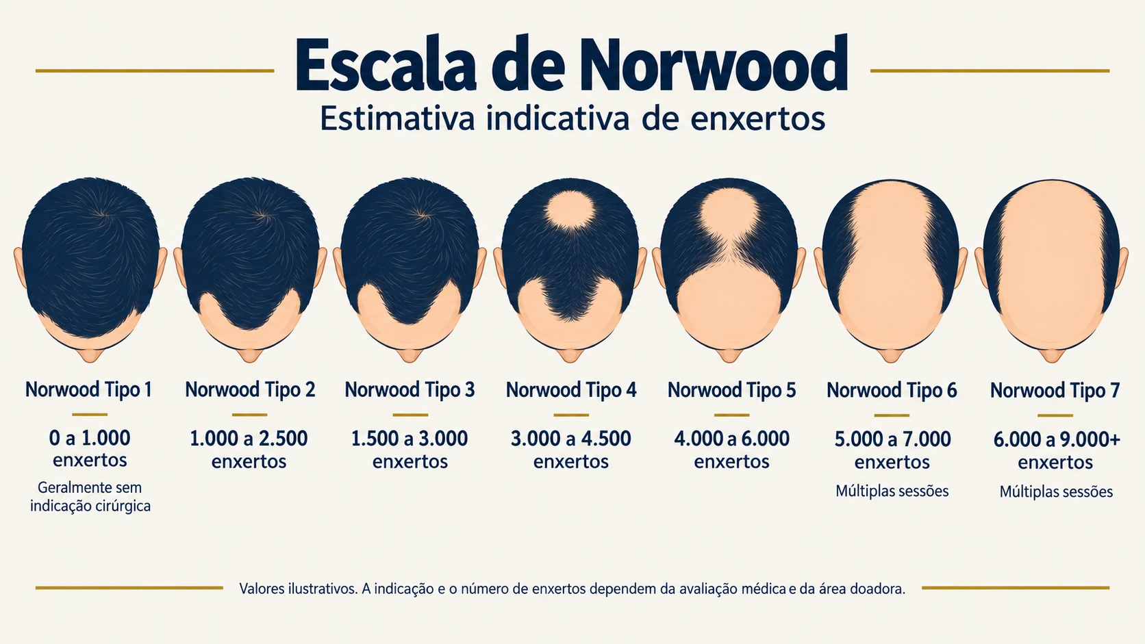 Escala de Norwood do Tipo 1 ao Tipo 7 com o número indicativo de enxertos para cada grau de queda de cabelo masculina