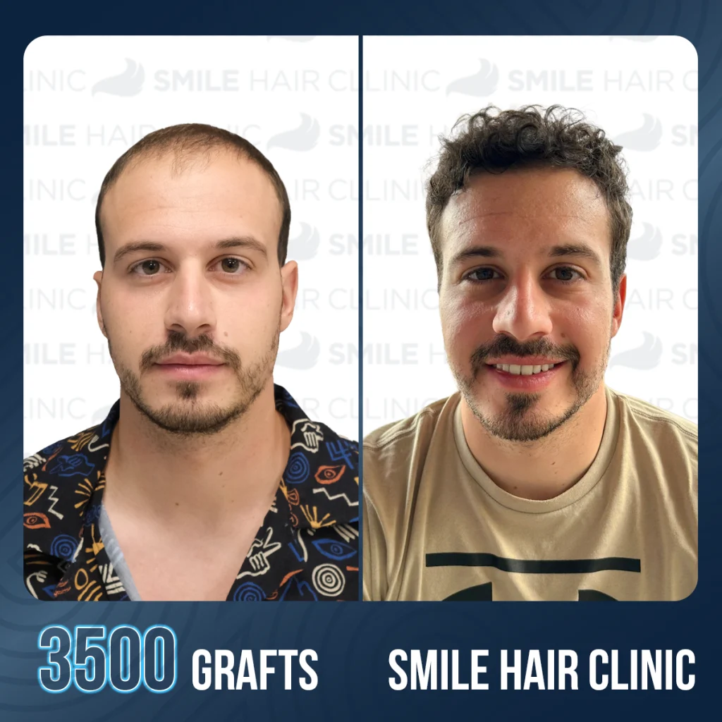 Mo Salah Hair Transplant: Before After, Technique & Hairline Analysis