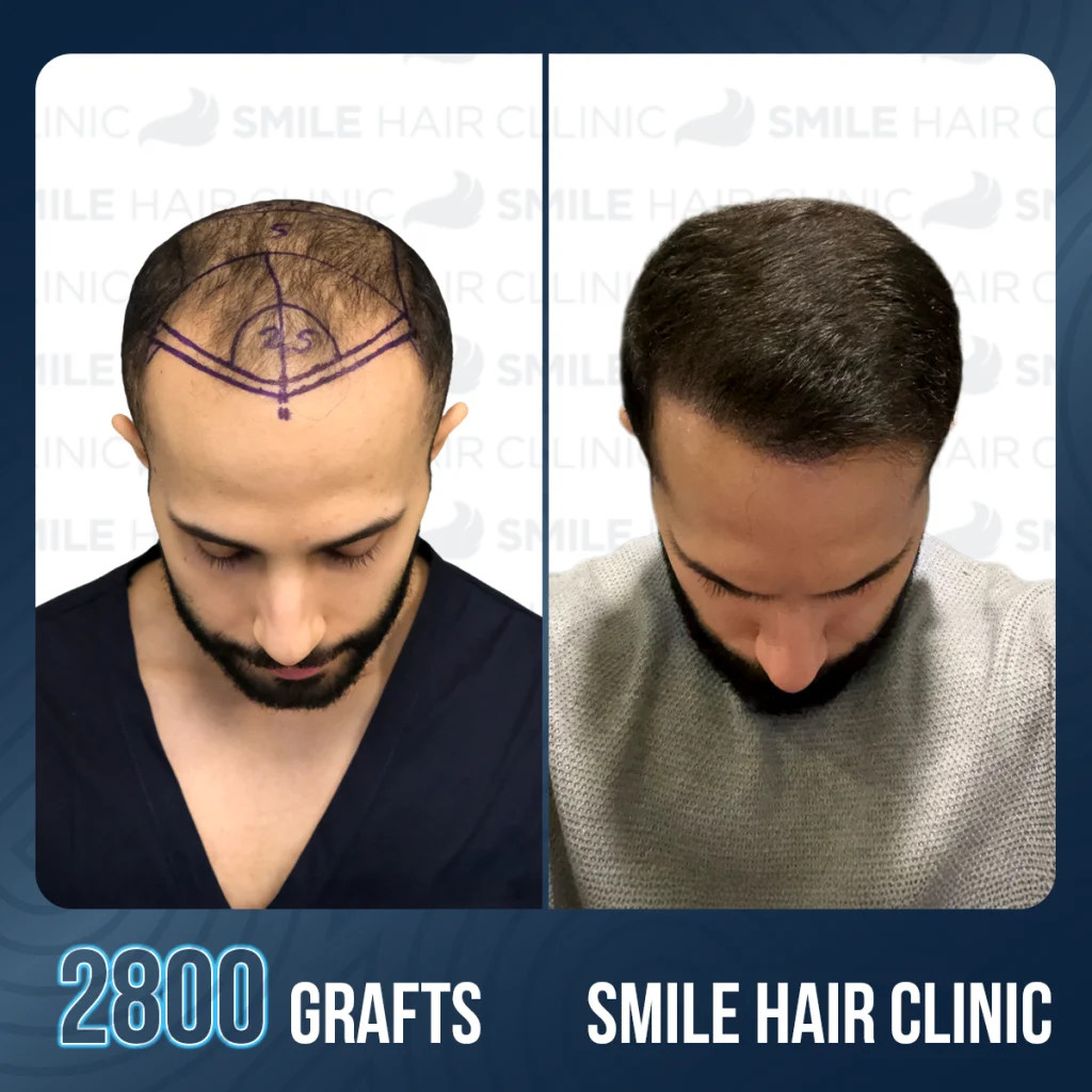 Widow's Peak Hair Transplant: Create or Remove a V-Shaped Hairline