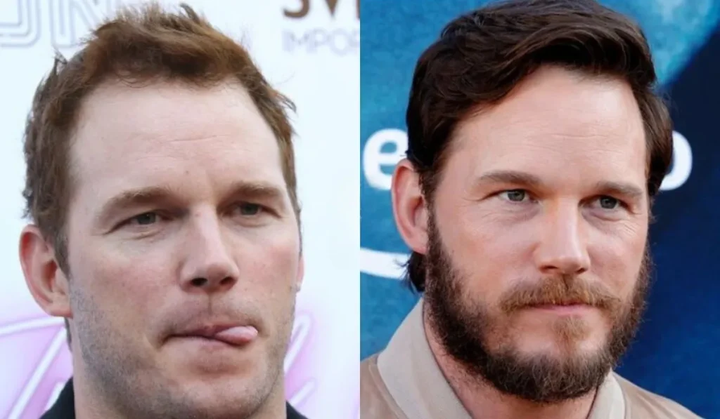 chris pratt hair transplant