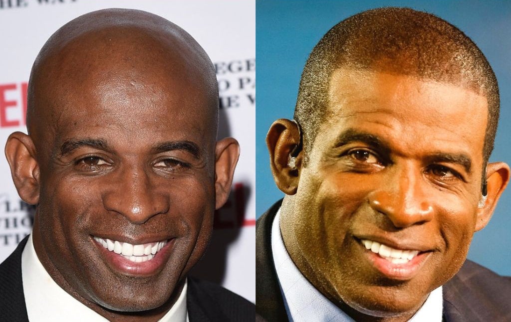 Deion Sanders hair transplant
