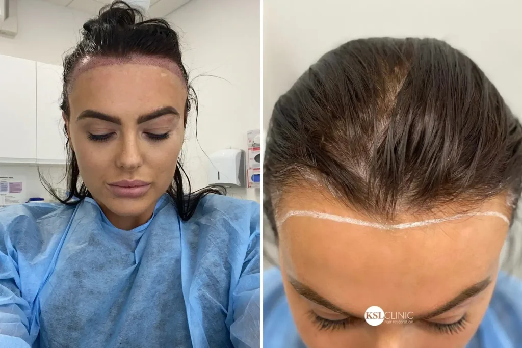 Hair Transplant Female Celebrities: Before After, Cost & Results 3 Hair Transplant Female Celebrities: Before After, Cost & Results