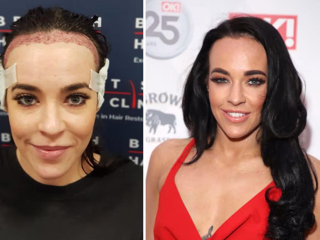 Hair Transplant Female Celebrities: Before After, Cost & Results 2 Hair Transplant Female Celebrities: Before After, Cost & Results