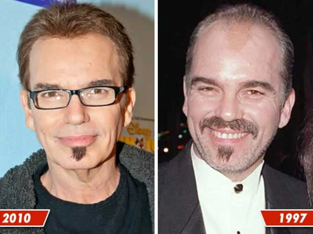 Billy Bob Thornton Hair Transplant: Hairline Analysis & Natural Results Guide