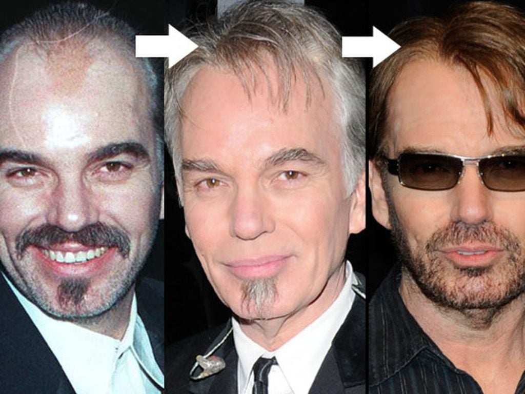 Billy Bob Thornton Hair Transplant: Hairline Analysis & Natural Results Guide