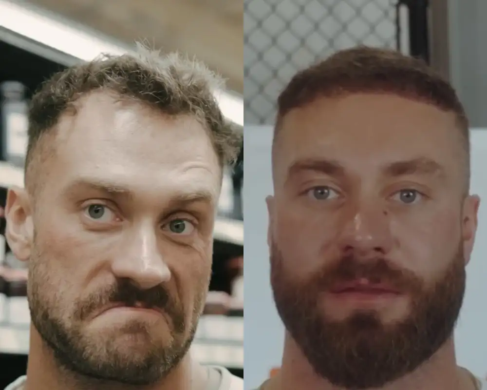 cbum hair transplant