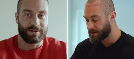 chris-bumstead-hair-transplant