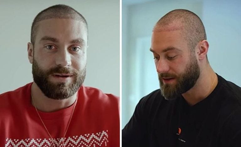 CBum Hair Transplant: Chris Bumstead Hairline Before After & Cost