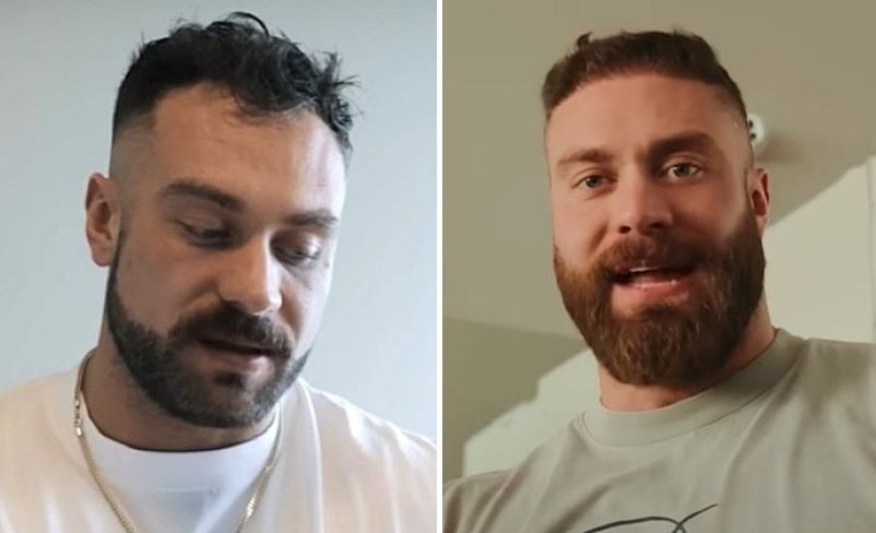 CBum Hair Transplant: Chris Bumstead Hairline Before After & Cost