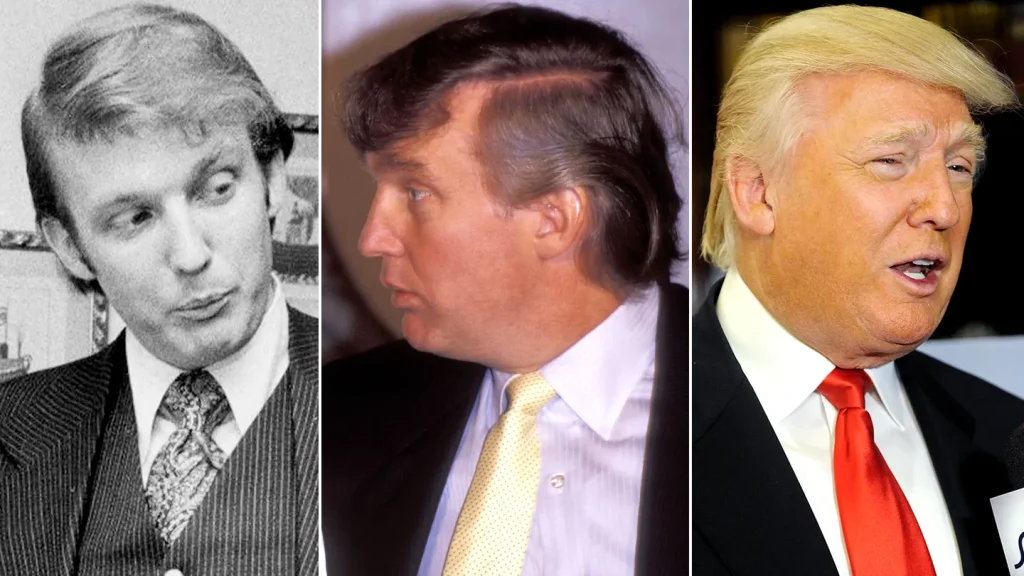 Trump Hair Transplant: Donald Trump Hair Surgery, Scalp Reduction