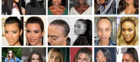 female-celebrity-hair-transplant