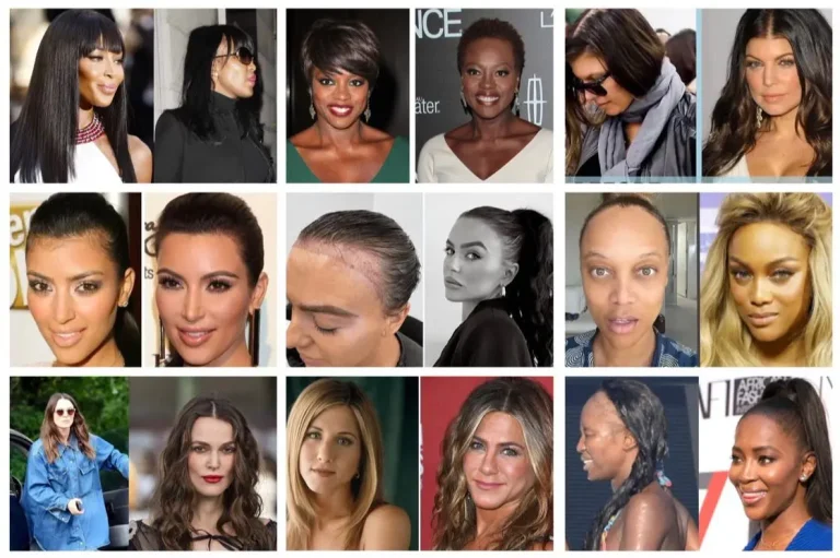 Hair Transplant Female Celebrities: Before After, Cost & Results