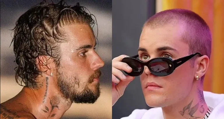 Justin Bieber Hair Transplant: Truth, Hairline Analysis & Real Options