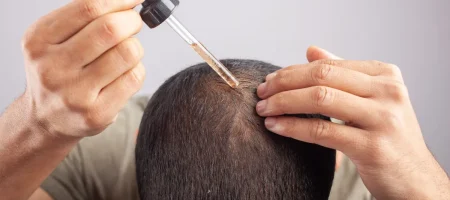 minoxidil-for-hair-loss