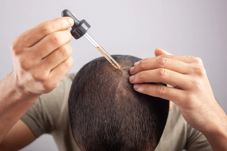 Minoxidil Saç Çizgisinde Etkili mi? Gerçek Sonuçlar ve Uzman Rehberi