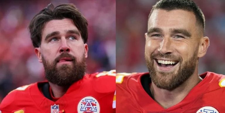 Travis Kelce Hair Transplant: Before After, Hairline Analysis & Cost