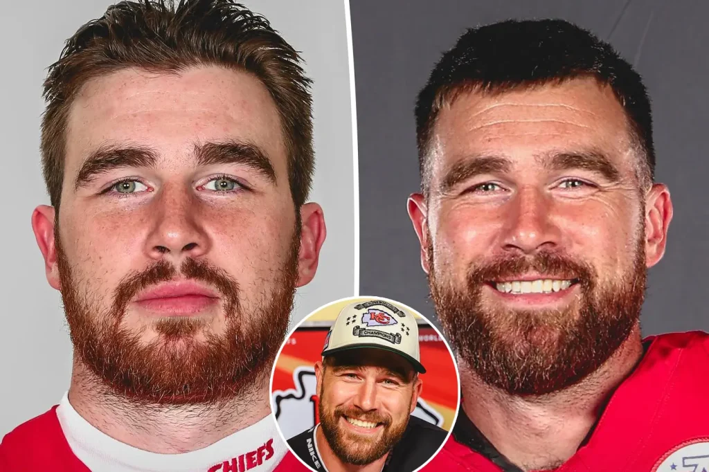 Travis Kelce Hair Transplant: Before After, Hairline Analysis & Cost 1 travis kelce hair transplant