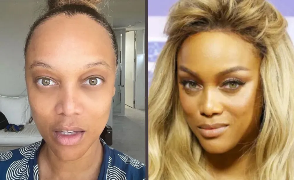 Hair Transplant Female Celebrities: Before After, Cost & Results 6 Hair Transplant Female Celebrities: Before After, Cost & Results