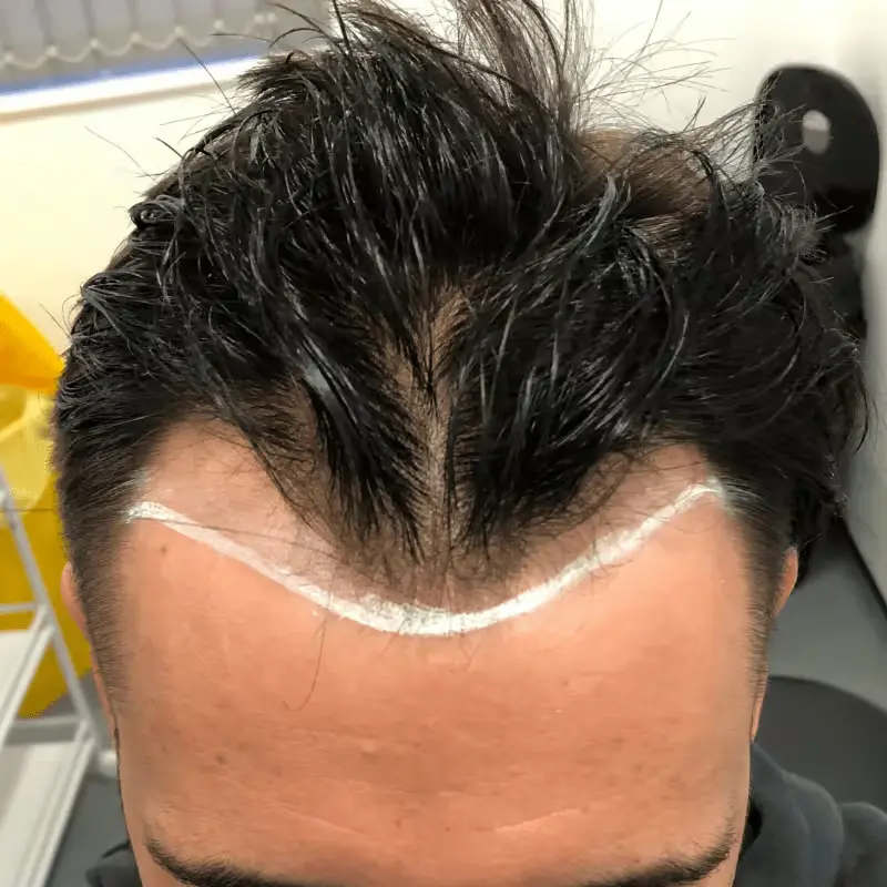 widow's peak hair transplant